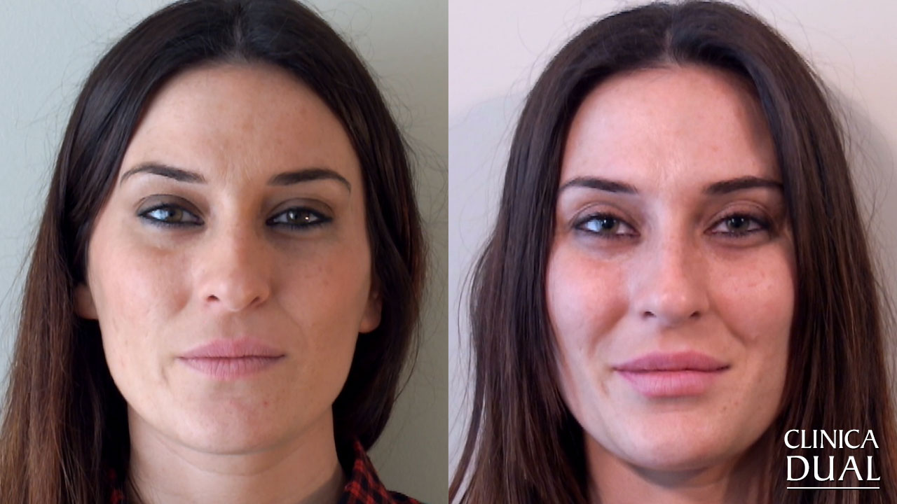 Фото до и после процедуры по увеличению губ в клинике Dual в Валенсии