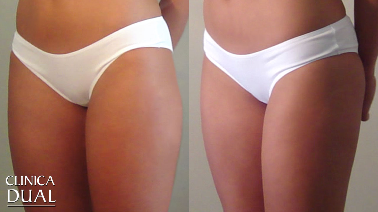 Before-and-After Localized Fat Treatment pictures | Clínica Dual Valencia