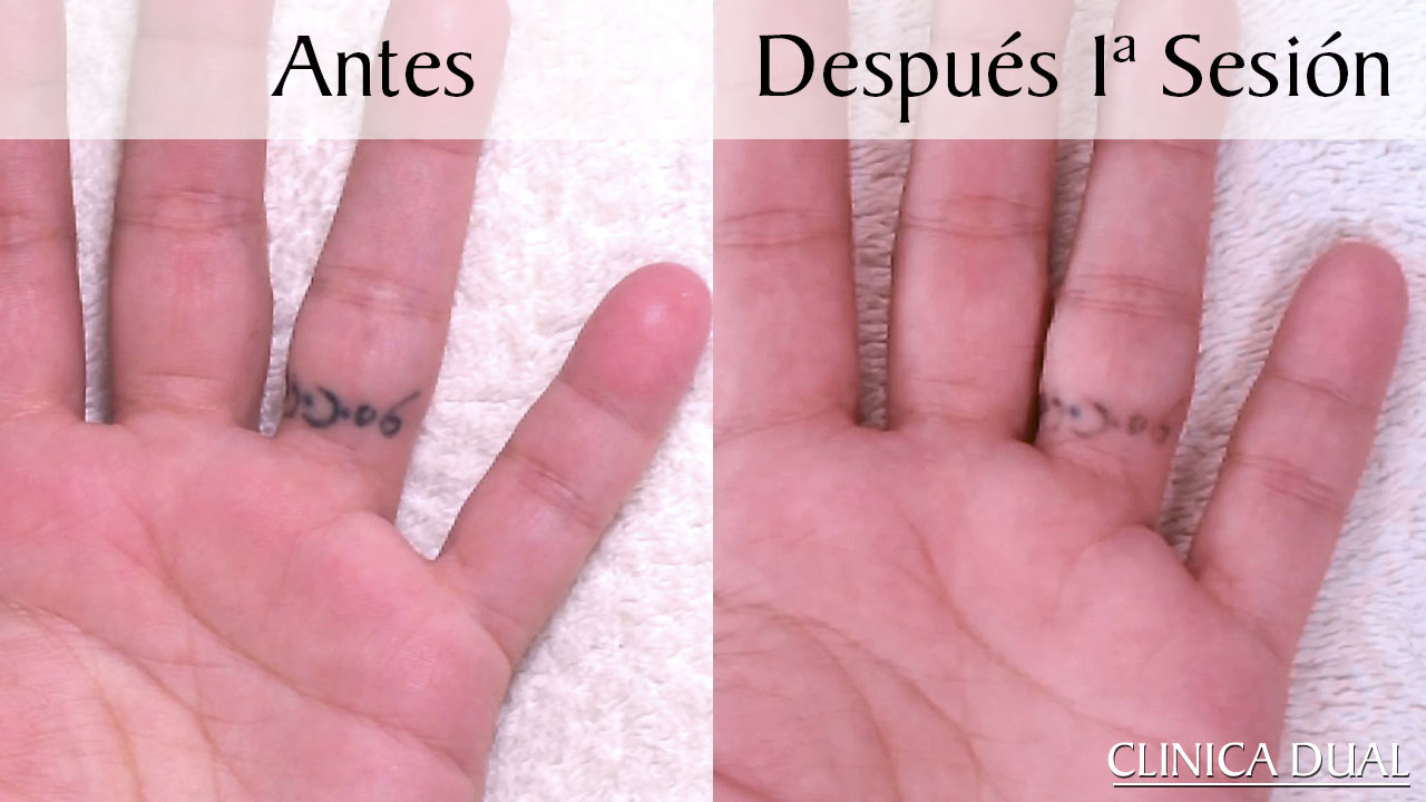 Fotos antes y después de tratamiento de eliminación de tatuajes. Clínica Dual Valencia