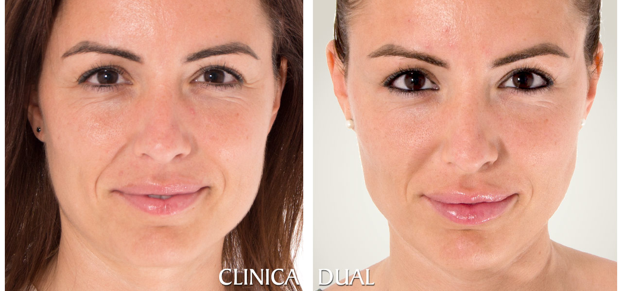 Fotos de antes y después de un Aumento de Labios - Vista frontal | Clínica Dual Valencia
