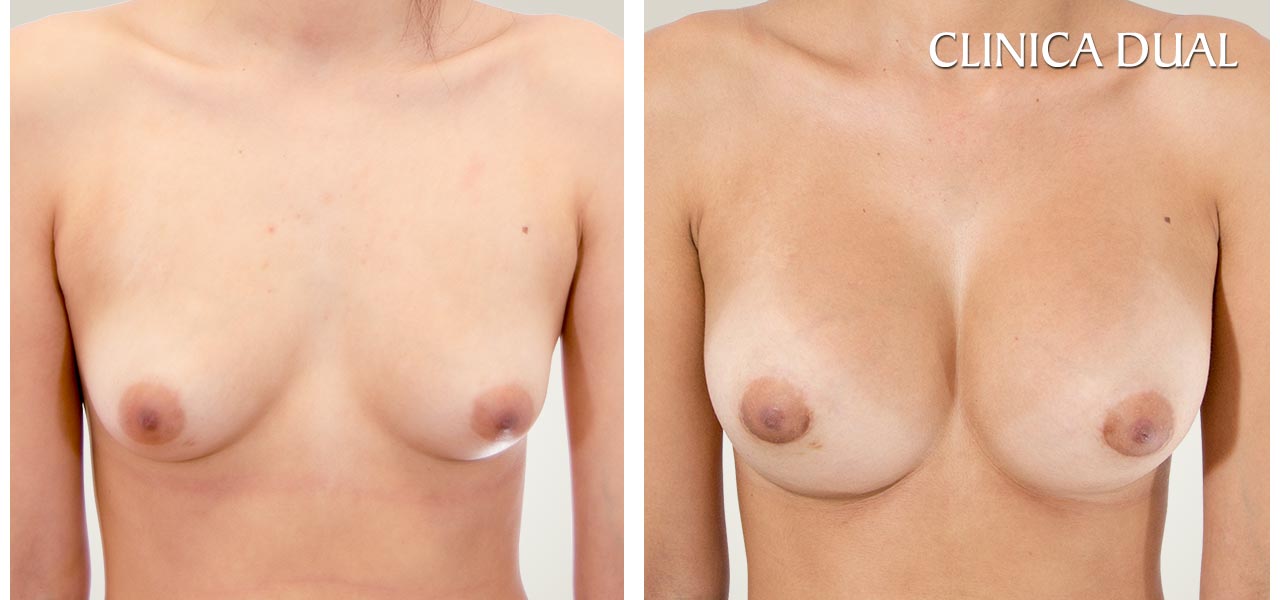 Before and after a Breast Augmentation photos | Clinica Dual Valencia