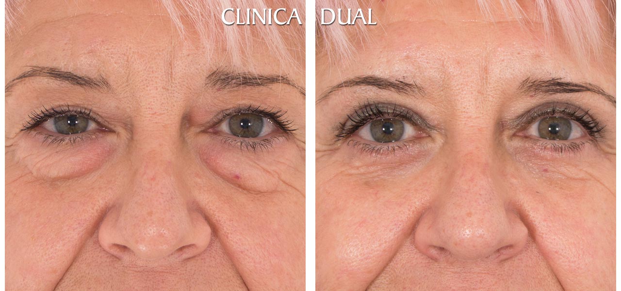 Fotos de antes y después de una Blefaroplastia de Bolsas de los Ojos - Vista frontal | Clínica Dual Valencia