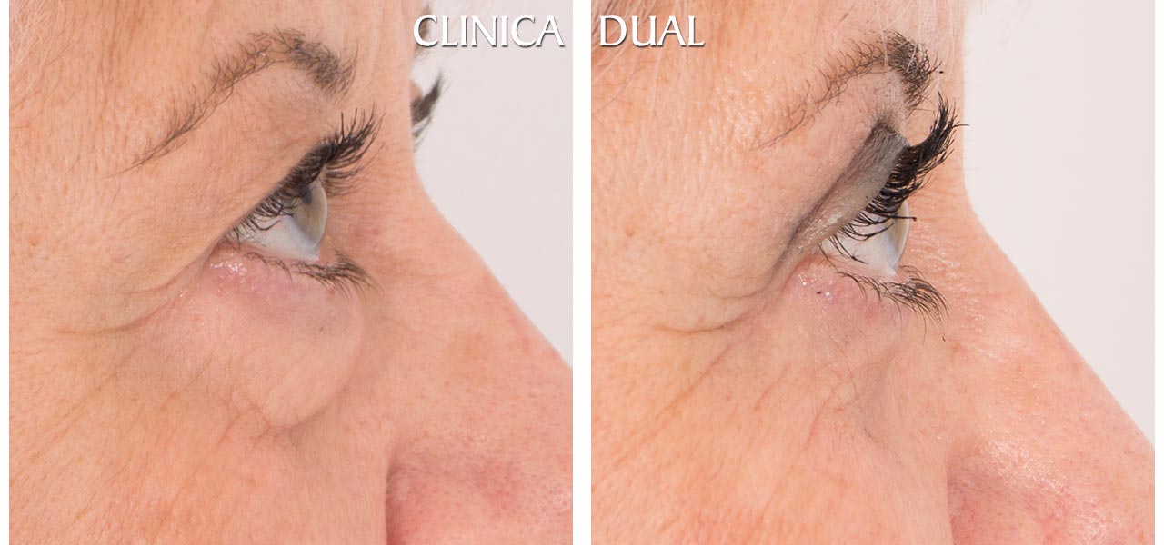 Fotos de antes y después de una Blefaroplastia de Bolsas de los Ojos - Vista lateral | Clínica Dual Valencia