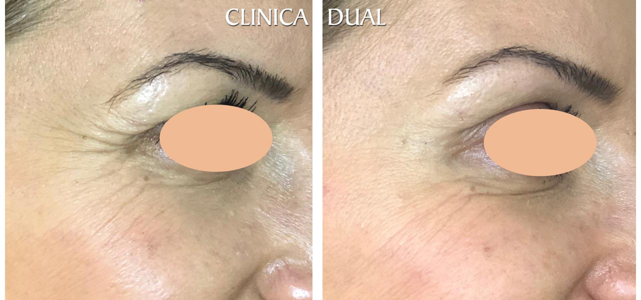 Fotos de antes y después de un tratamiento de Bótox - Vista lateral - Clínica Dual Valencia