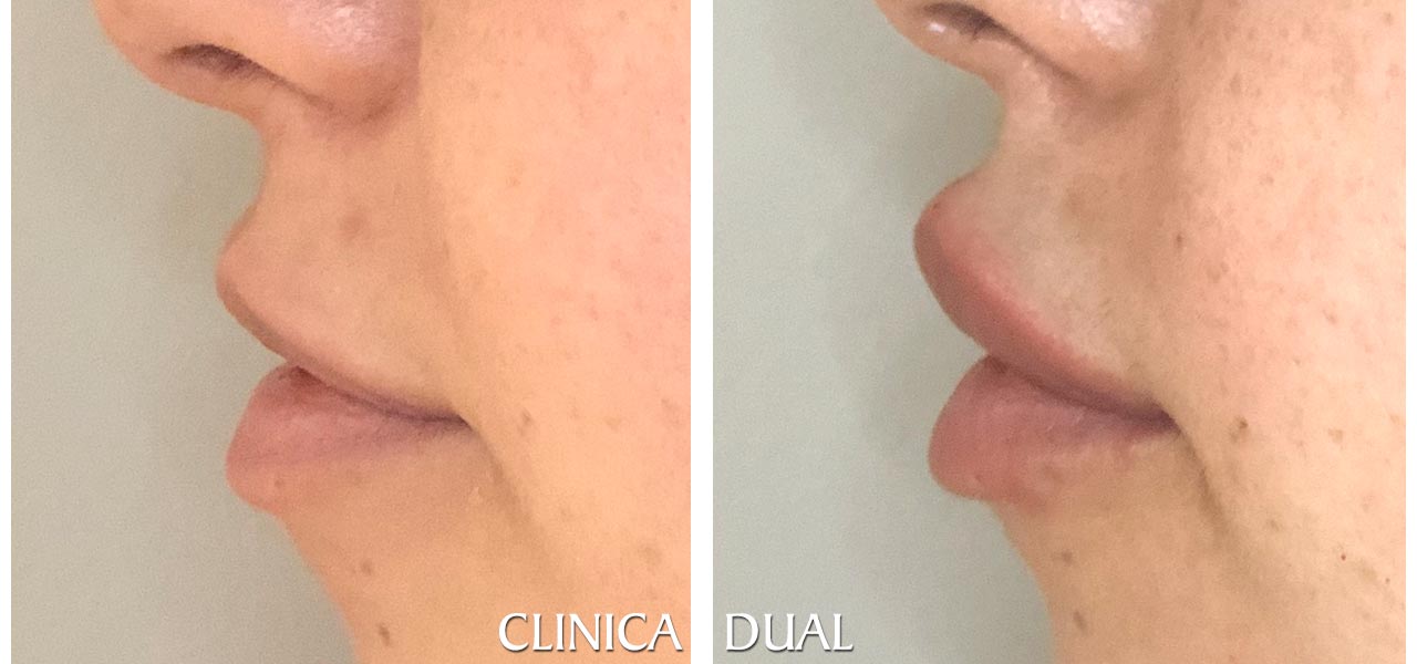 Fotos de antes y después de un Aumento de Labios - Vista lateral | Clínica Dual Valencia