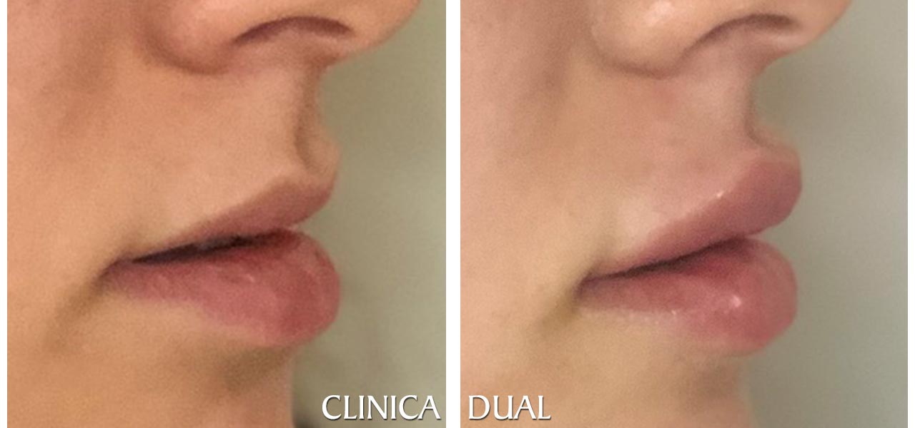 Fotos de antes y después de un Aumento de Labios - Vista lateral | Clínica Dual Valencia