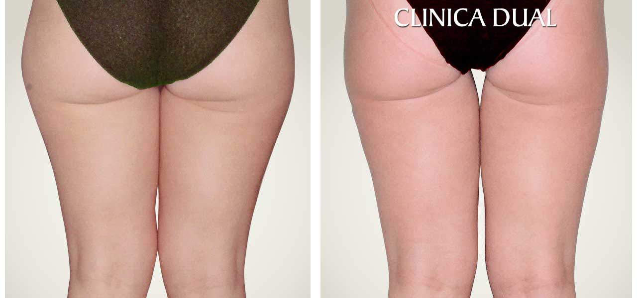 Fotos de antes y después de una Liposucción - Vista trasera - Clínica Dual Valencia