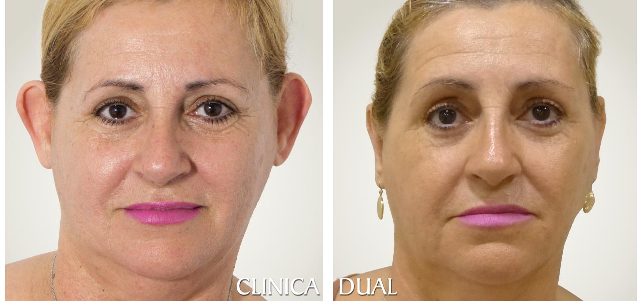 Otoplastia - Fotos antes y después de una operación de orejas - vista frontal | Clínica Dual
