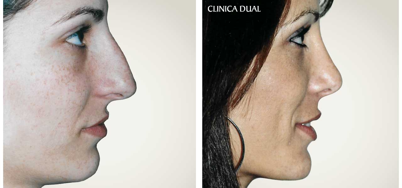 Fotos de antes y después de una Rinoplastia de nariz - Vista de perfil - Clínica Dual Valencia